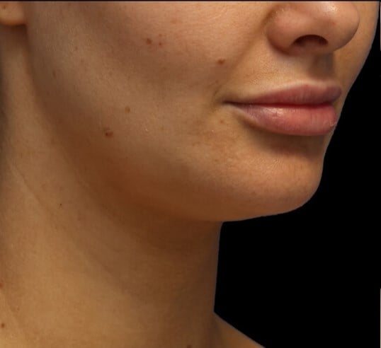 Awake Neck Liposuction Before