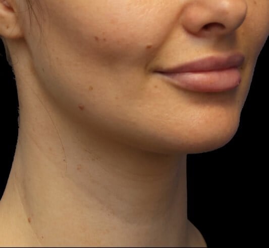 Awake Neck Liposuction After