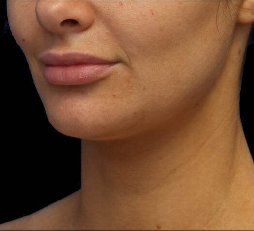 Awake Neck Liposuction Before