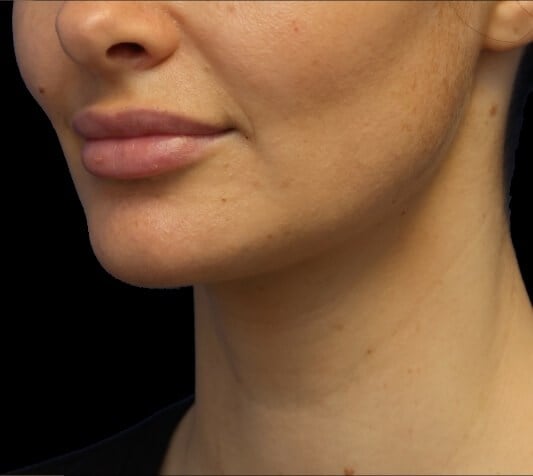 Awake Neck Liposuction After