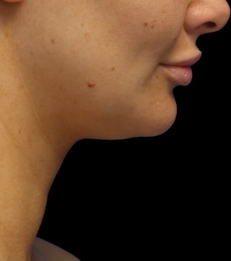 Awake Neck Liposuction Before