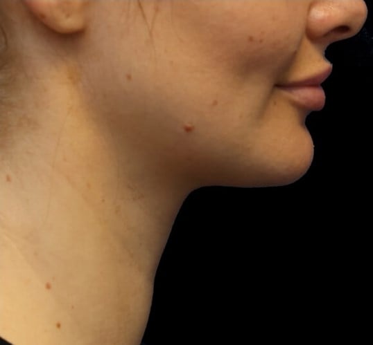 Awake Neck Liposuction After