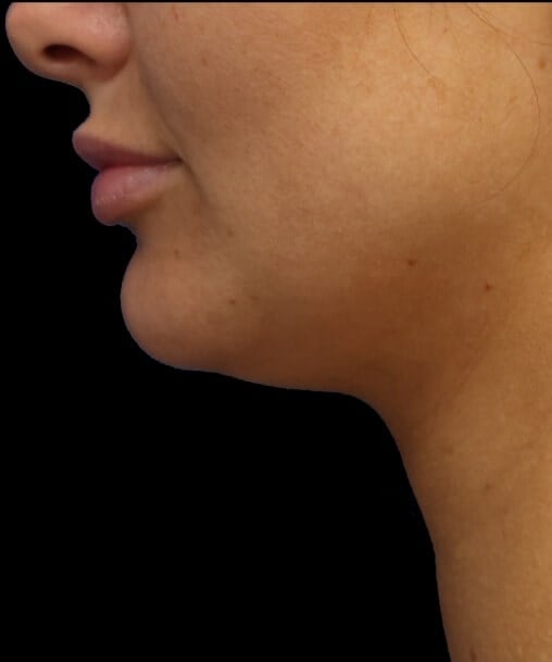 Awake Neck Liposuction Before