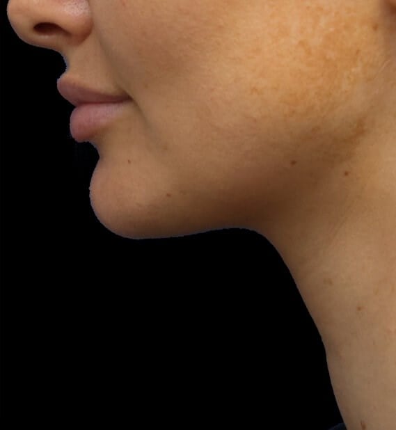 Awake Neck Liposuction After