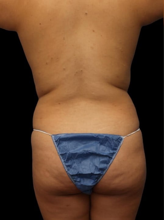 Awake Liposuction 360 Before