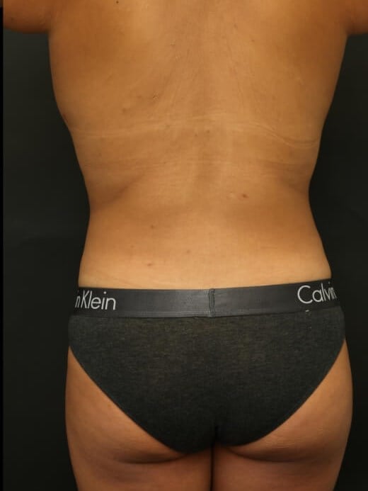 Awake Liposuction 360 After