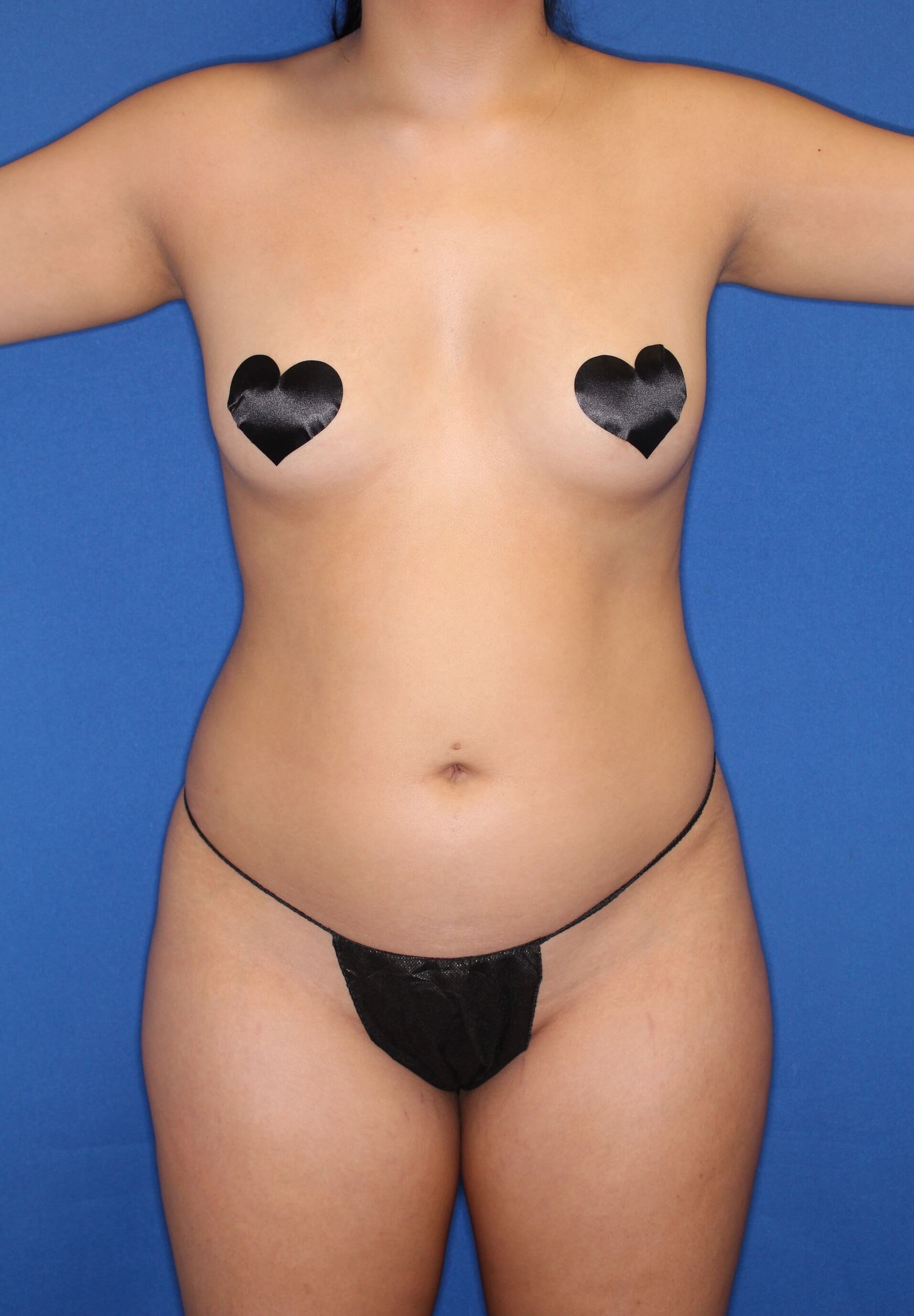 Awake Liposuction 360 Before