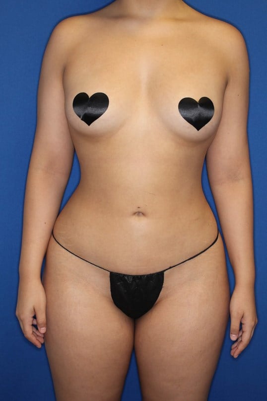 Awake Liposuction 360 After