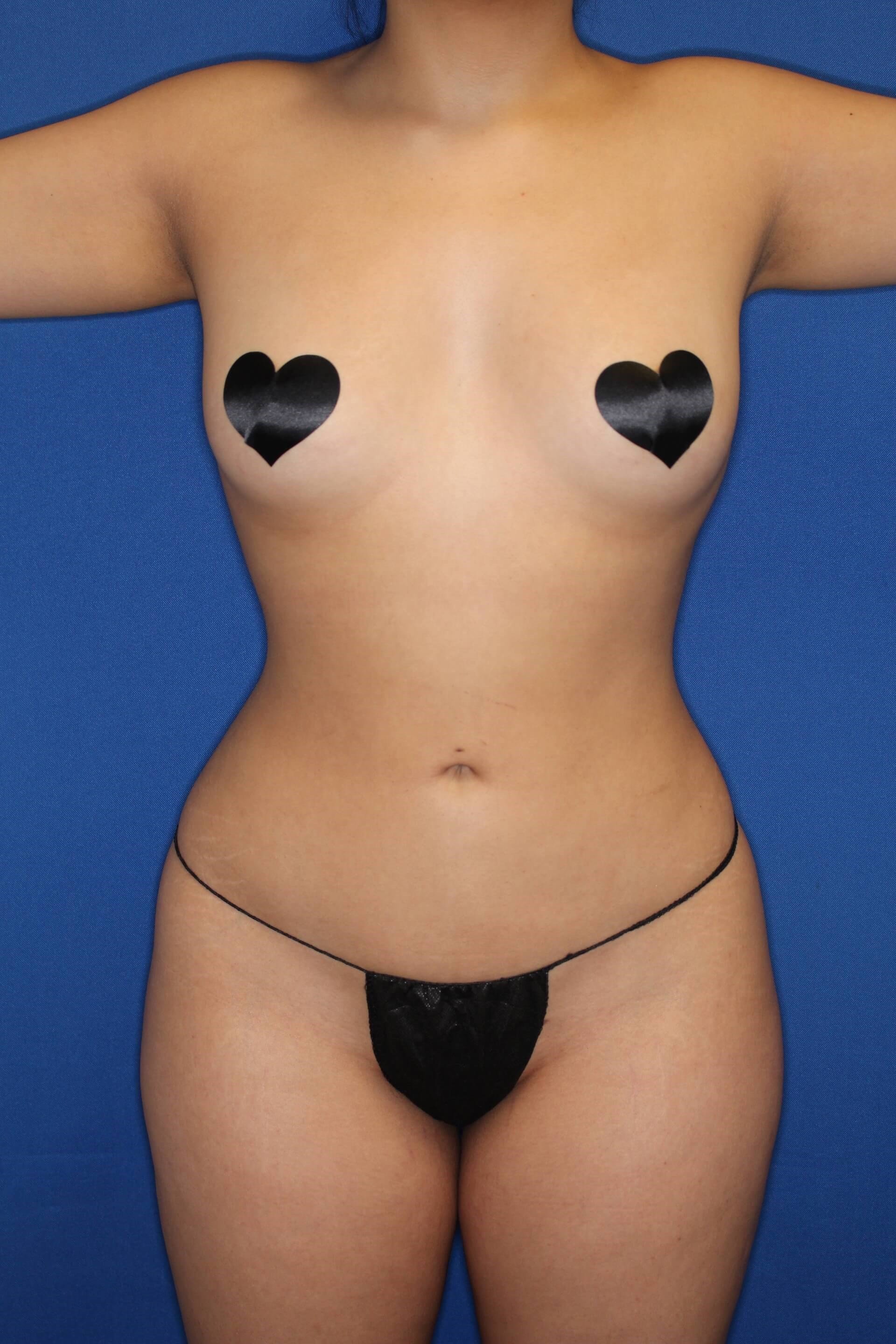 Awake Liposuction 360 After