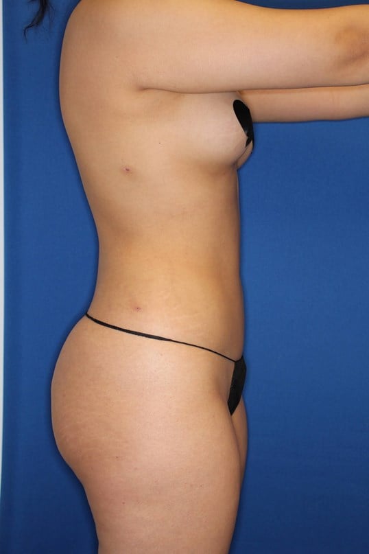 Awake Liposuction 360 After