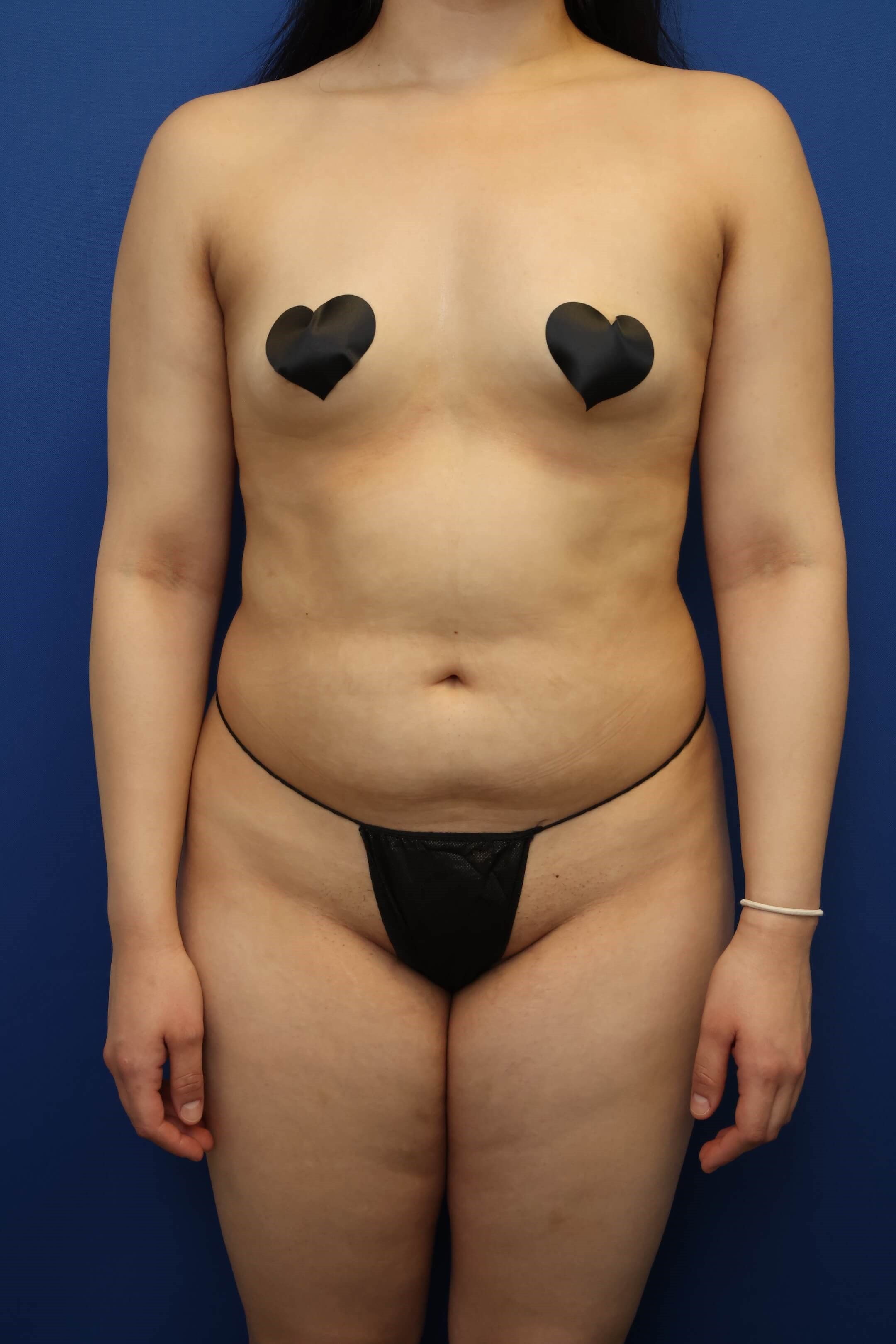 Awake Liposuction 360 Before
