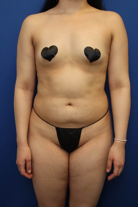 Awake Liposuction 360 Before