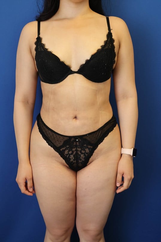 Awake Liposuction 360 After