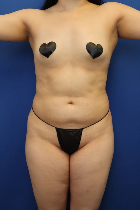 Awake Liposuction 360 Before
