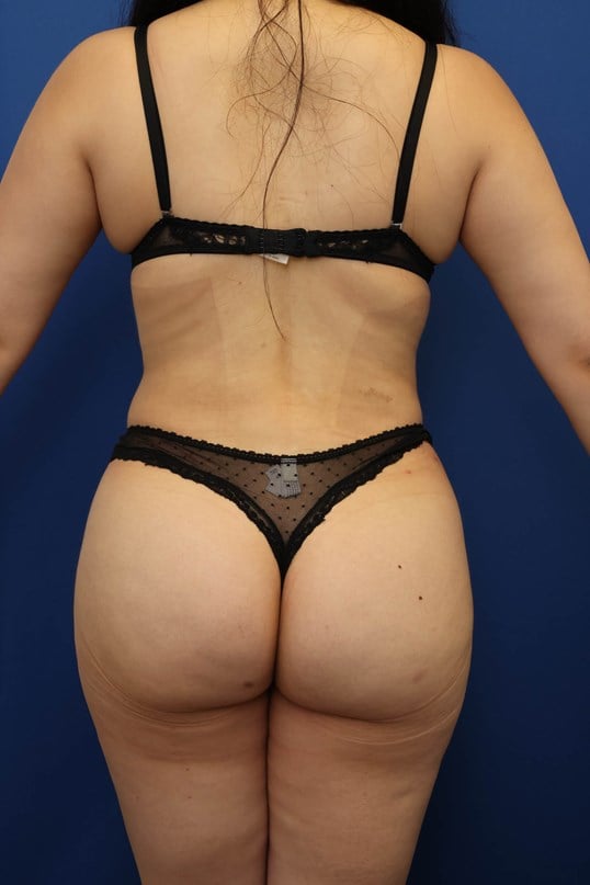 Awake Liposuction 360 After