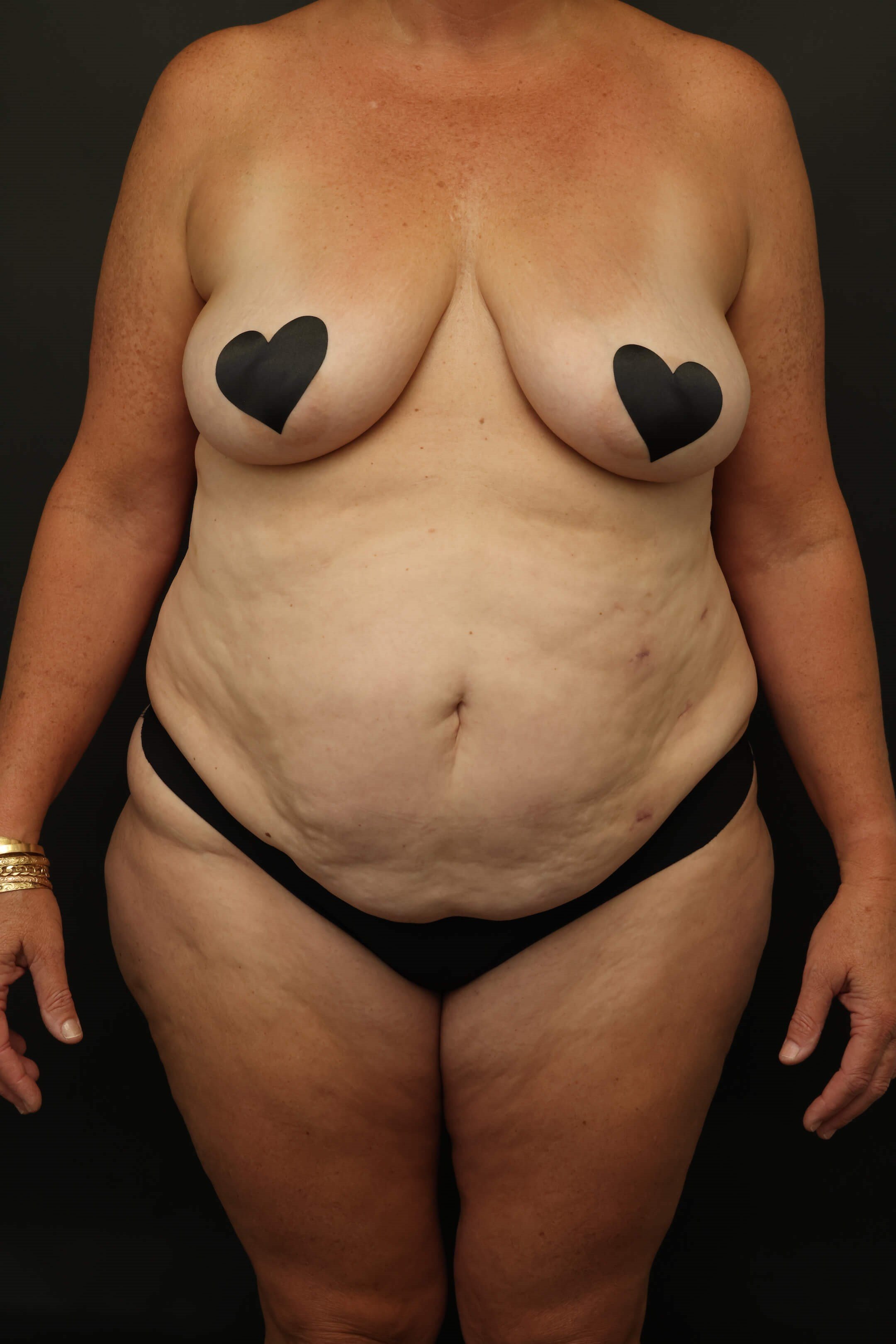 Mommy Makeover Before