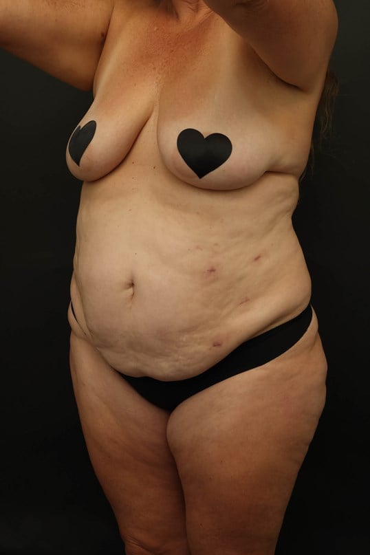 Mommy Makeover Before