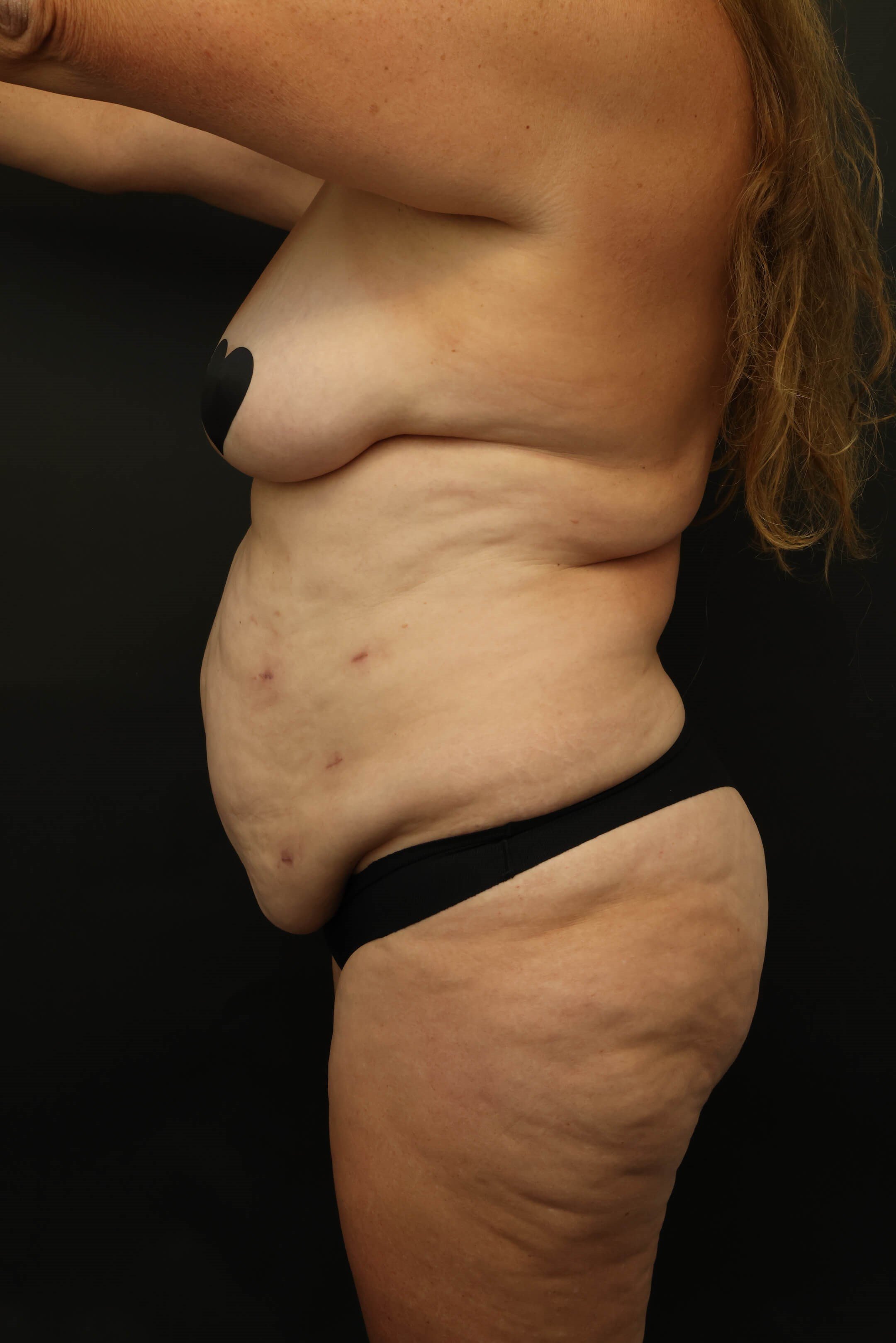 Mommy Makeover Before