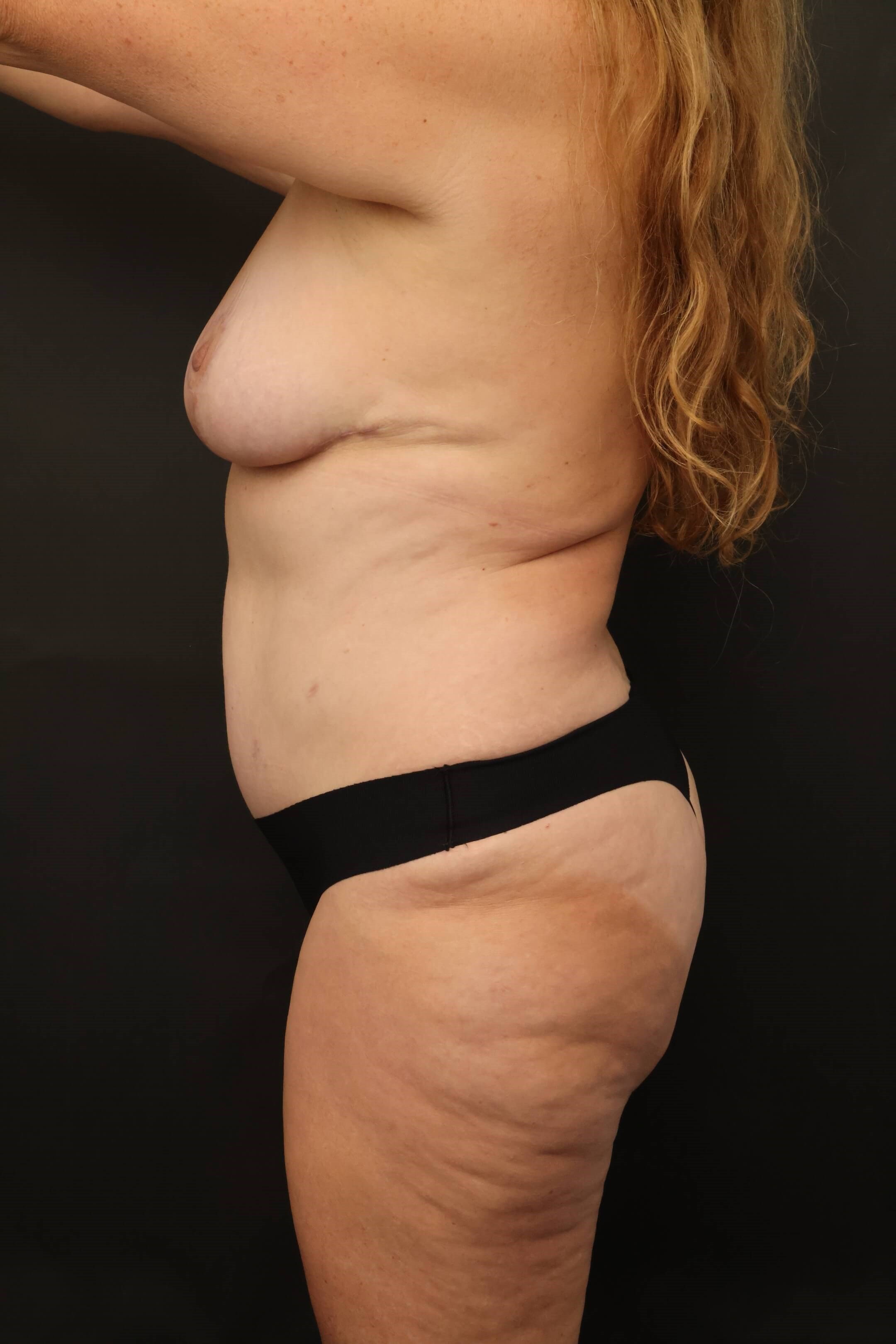 Mommy Makeover After