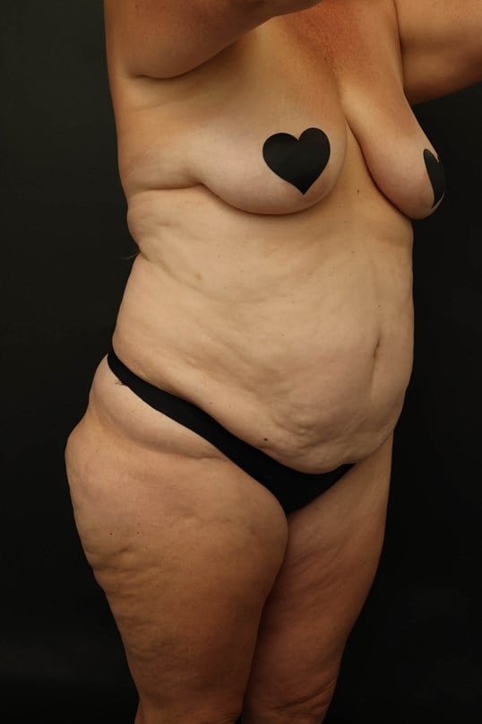 Mommy Makeover Before