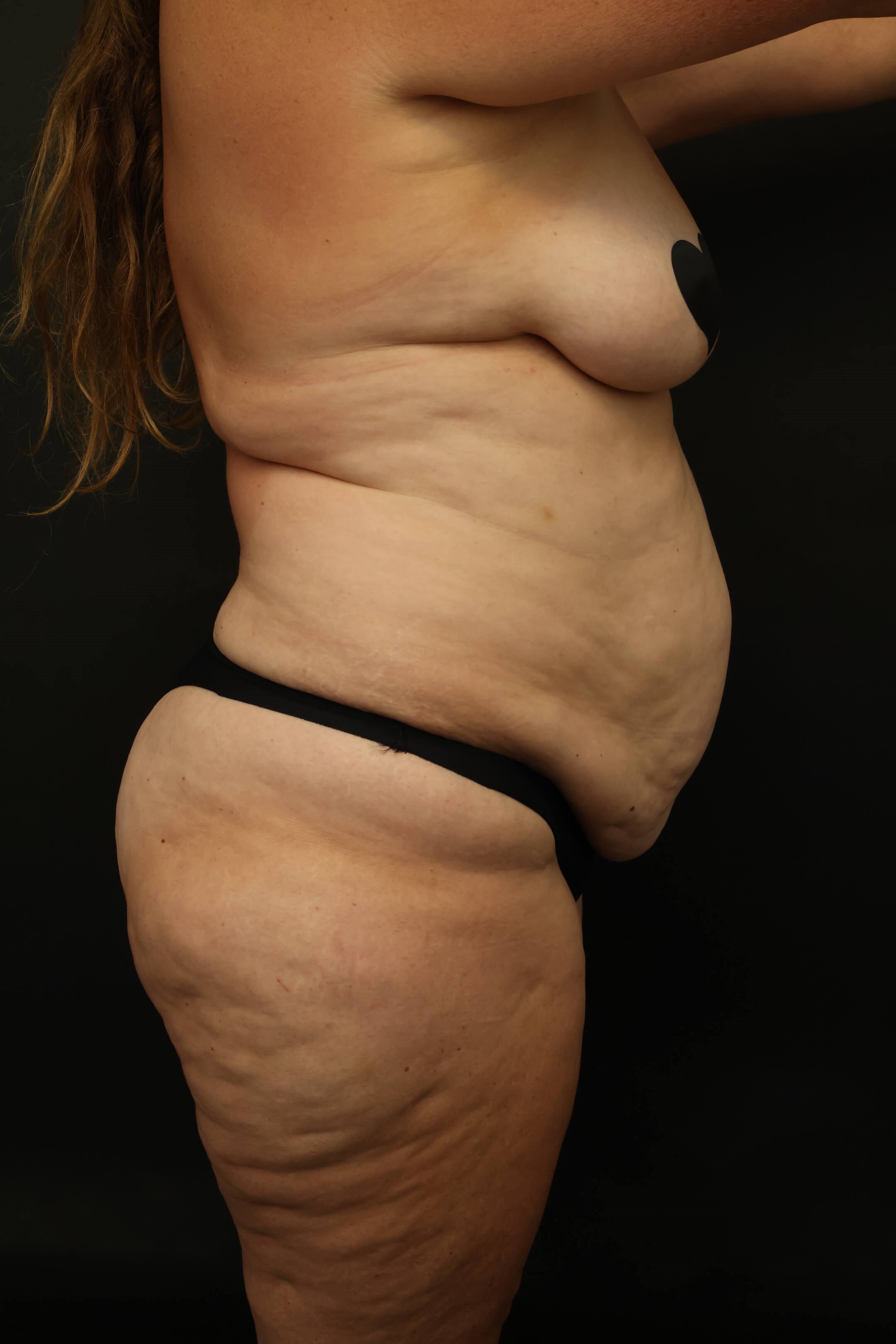 Mommy Makeover Before