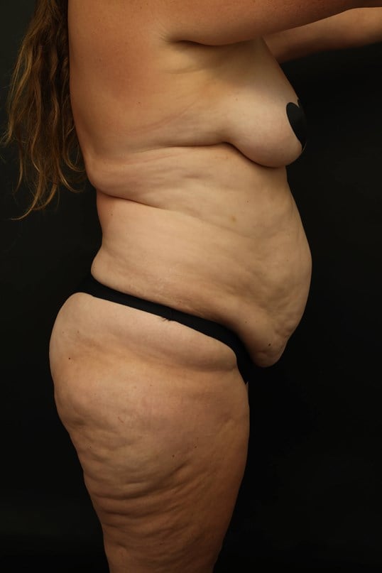 Mommy Makeover Before