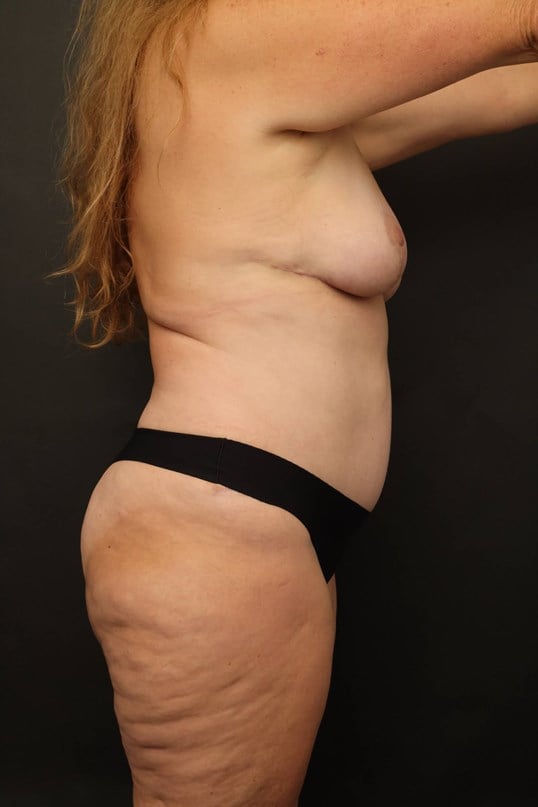 Mommy Makeover After