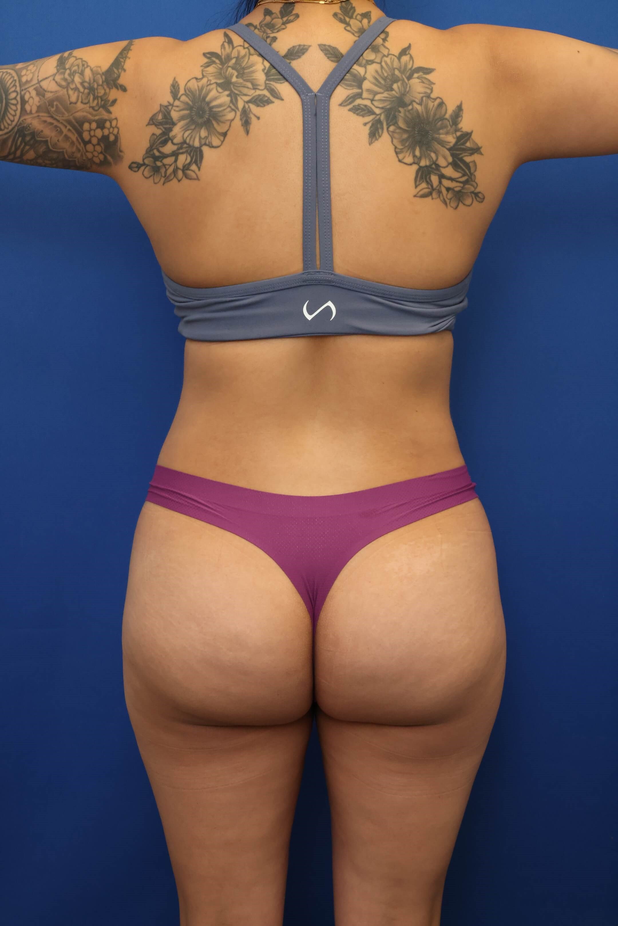 Awake Liposuction 360 After