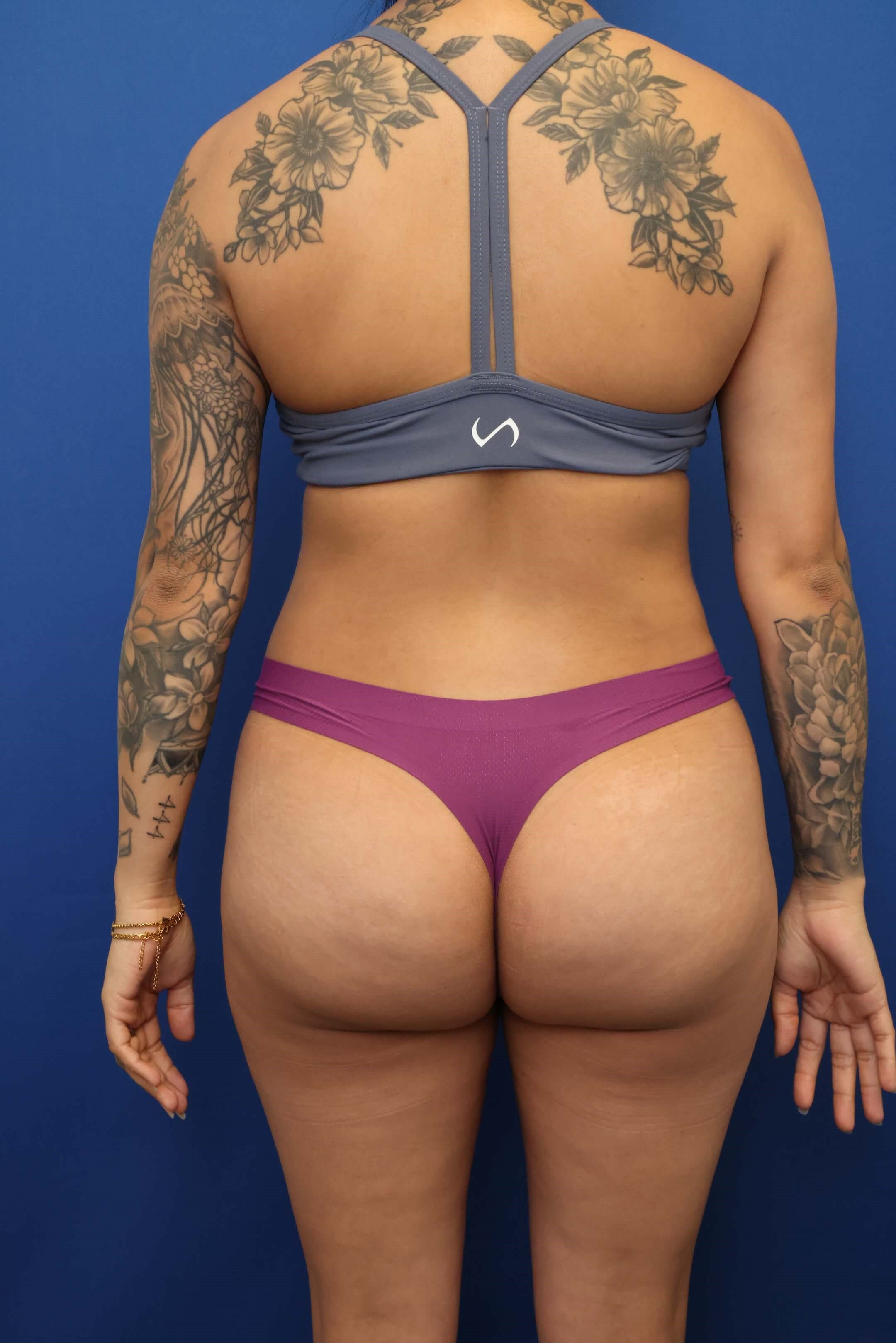 Awake Liposuction 360 After