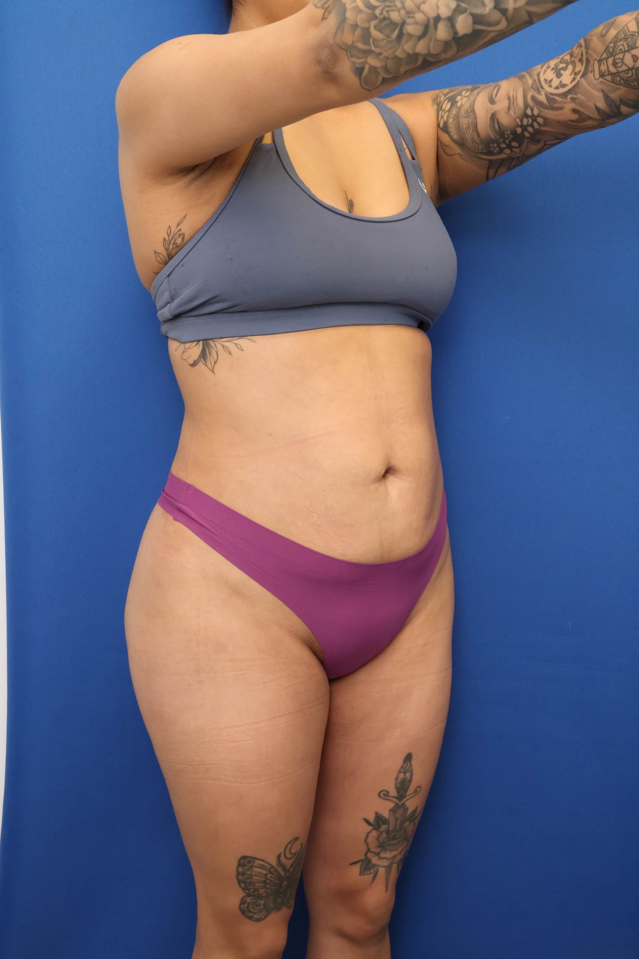 Awake Liposuction 360 After