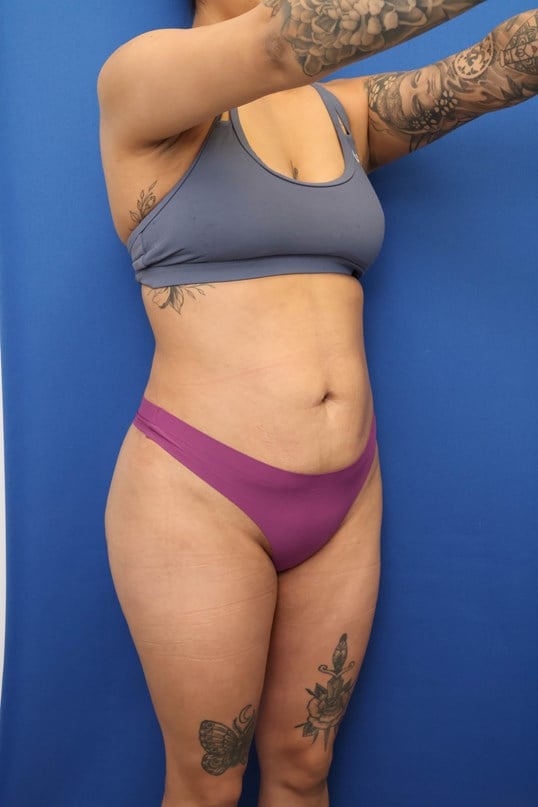 Awake Liposuction 360 After