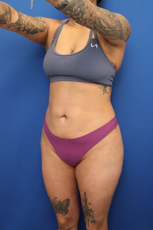 Awake Liposuction 360 After