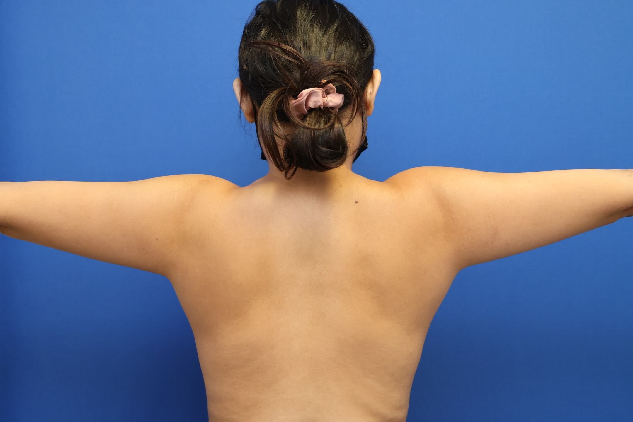 Awake Arm Liposuction Before