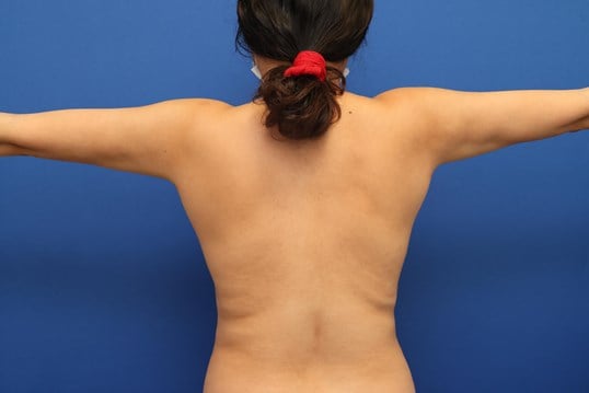 Awake Arm Liposuction After