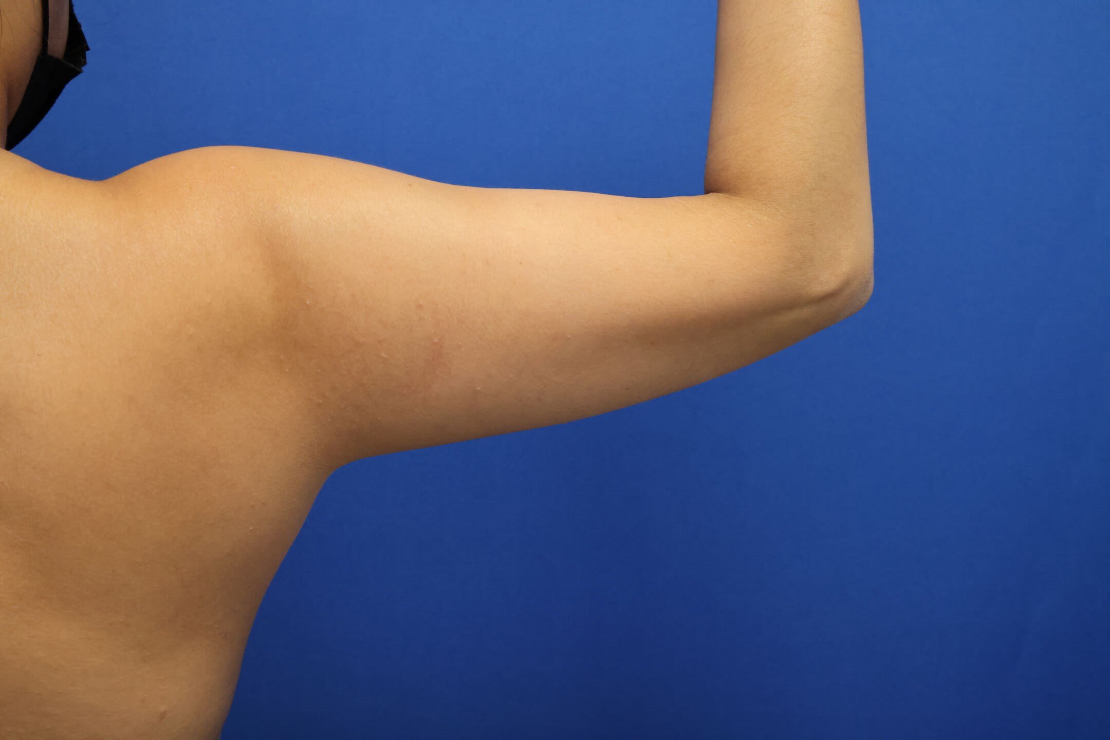 Awake Arm Liposuction Before