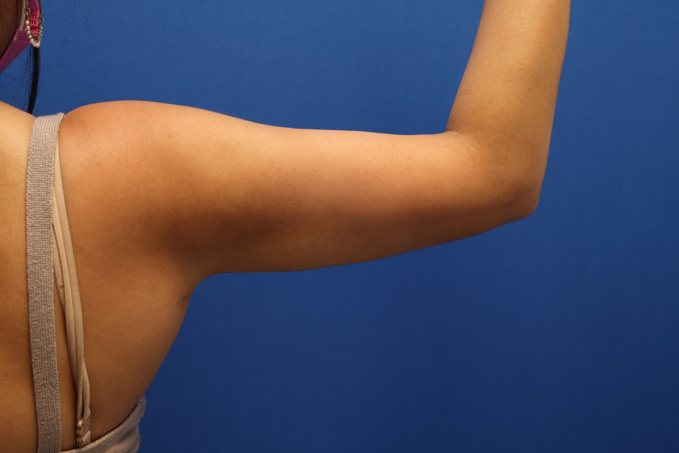Awake Arm Liposuction After