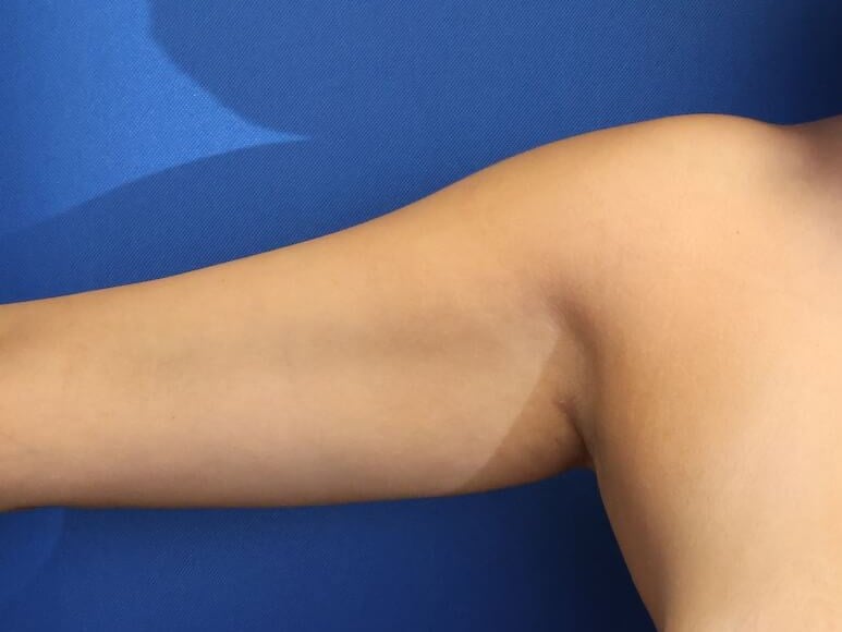 Awake Arm Liposuction Before