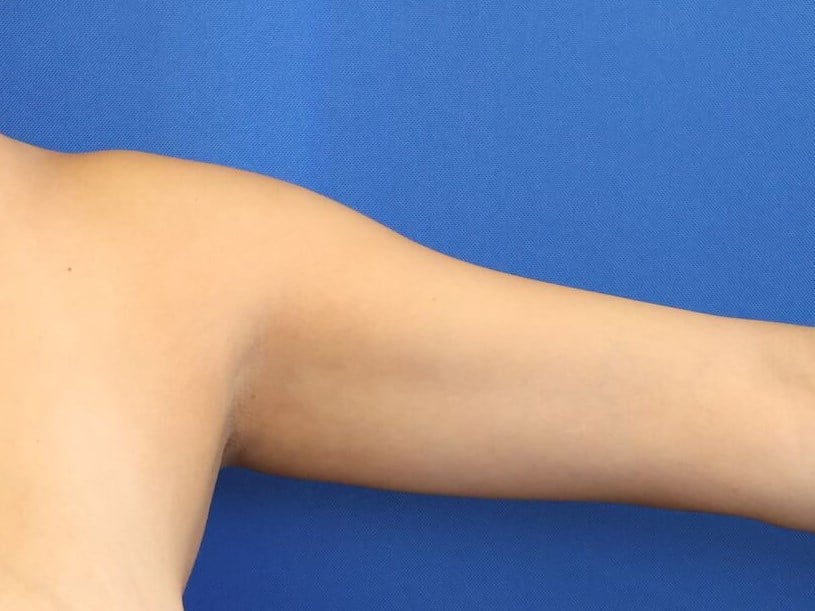 Awake Arm Liposuction Before