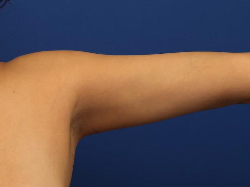 Awake Arm Liposuction After