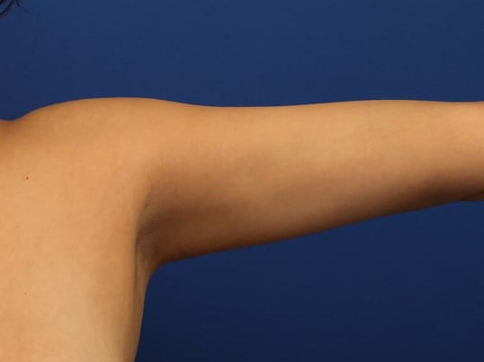 Awake Arm Liposuction After