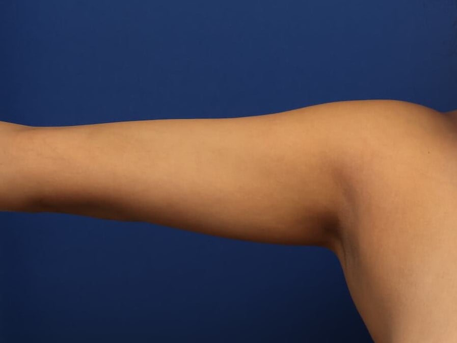 Awake Arm Liposuction After