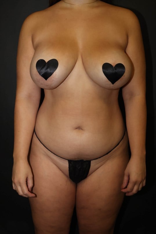 Awake Liposuction 360 Before