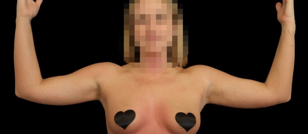 Awake Arm Liposuction Before