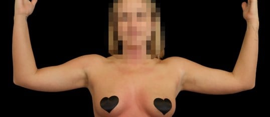 Awake Arm Liposuction Before