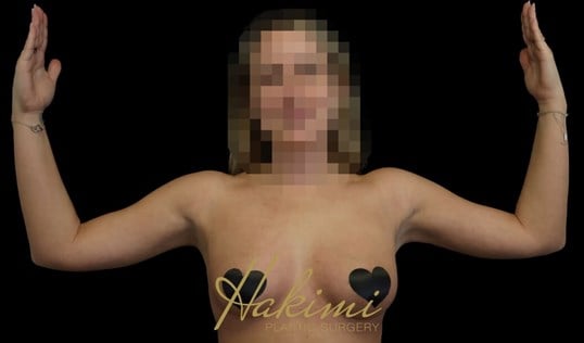 Awake Arm Liposuction After