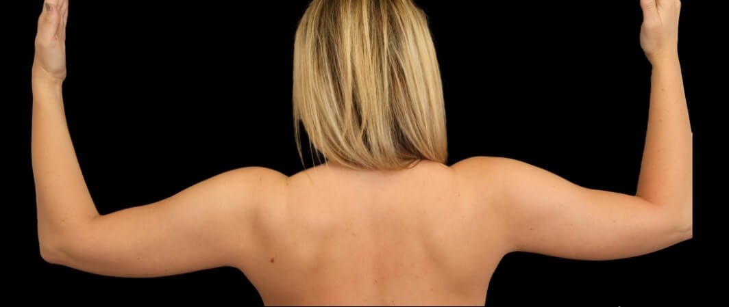 Awake Arm Liposuction Before