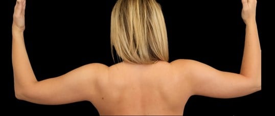 Awake Arm Liposuction Before