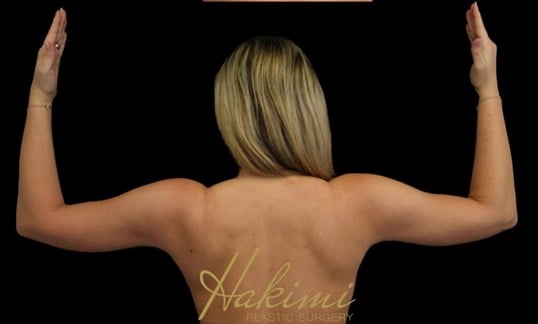 Awake Arm Liposuction After