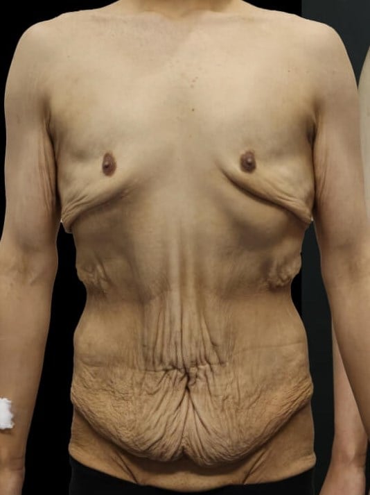 Tummy Tuck Before