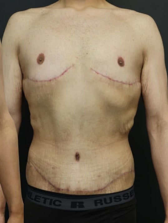 Tummy Tuck After
